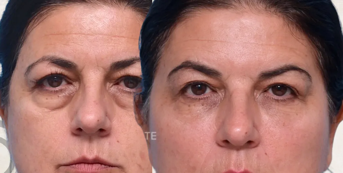 Fillers Pómulos